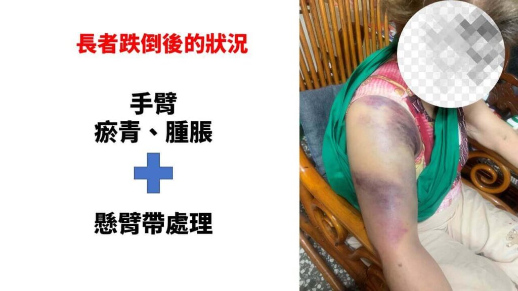 跌倒骨折該不該開刀 手臂狀況